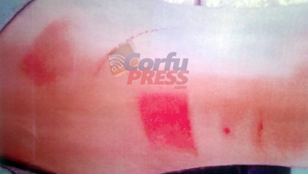 Καταγγελία για βασανιστήρια με καυτό λάδι και κλωτσιές σε εργαζόμενο εστιατορίου στην Κέρκυρα